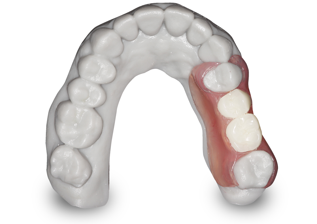 3d-printed-model-with-valplast-unilateral2_orig