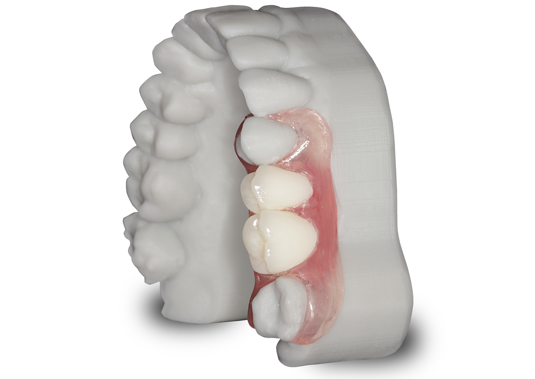 3d-printed-model-with-valplast-unilateral3_orig