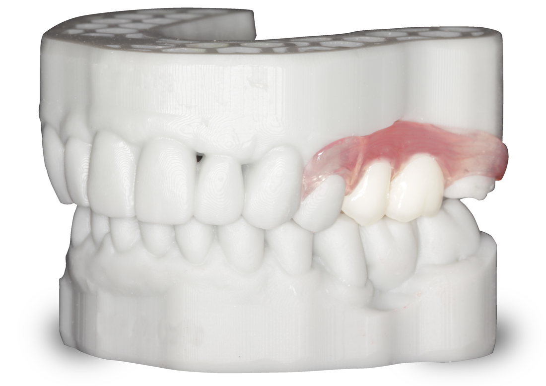 3d-printed-model-with-valplast-unilateral_orig