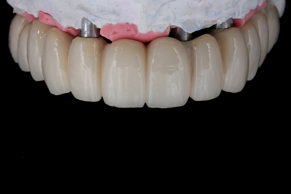 IMPLANT CROWN AND BRIDGE 6