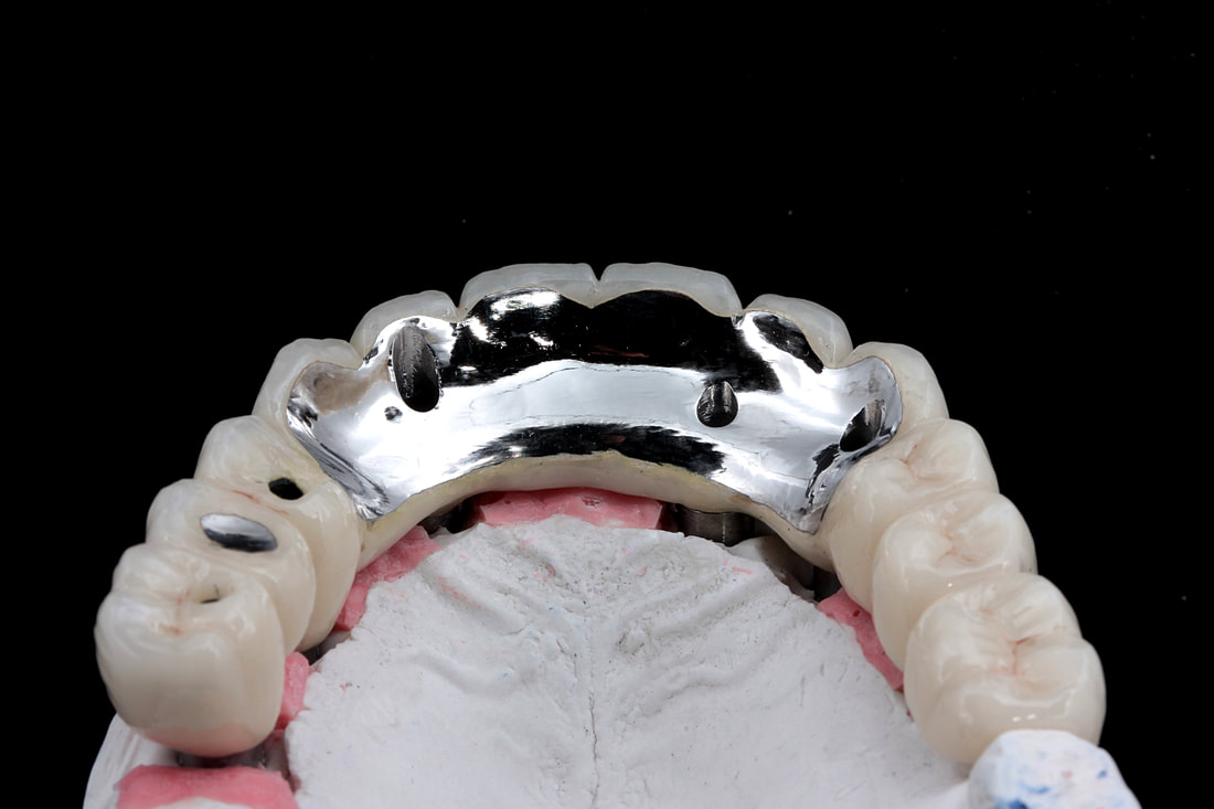 IMPLANT CROWN AND BRIDGE 7