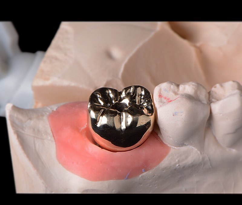 IMPLANT FULL METAL 1