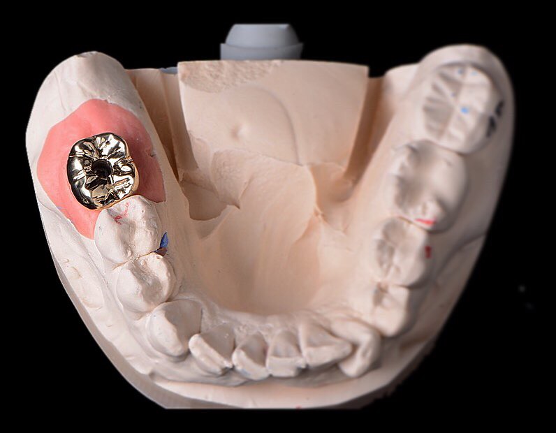 IMPLANT FULL METAL 5