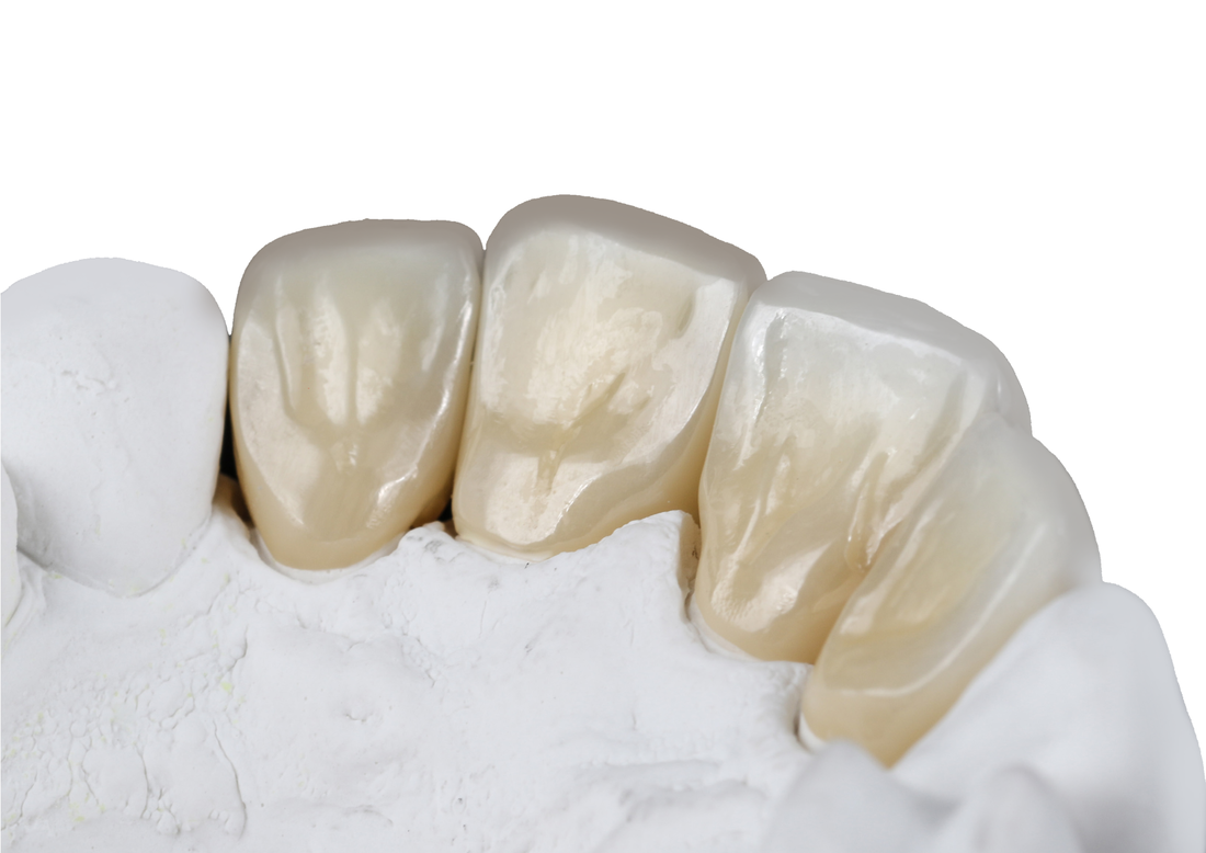 full-contour-zirconia-anterior-crowns_orig