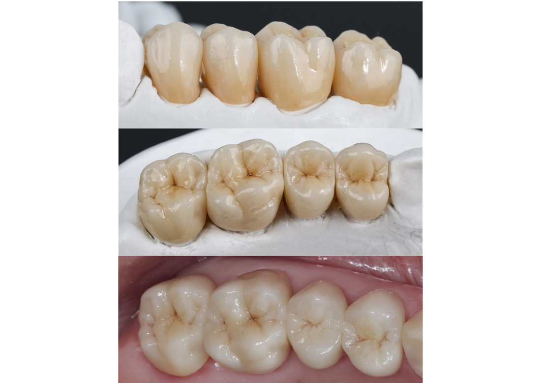 full-contour-zirconia-posterior-crowns-multi_orig
