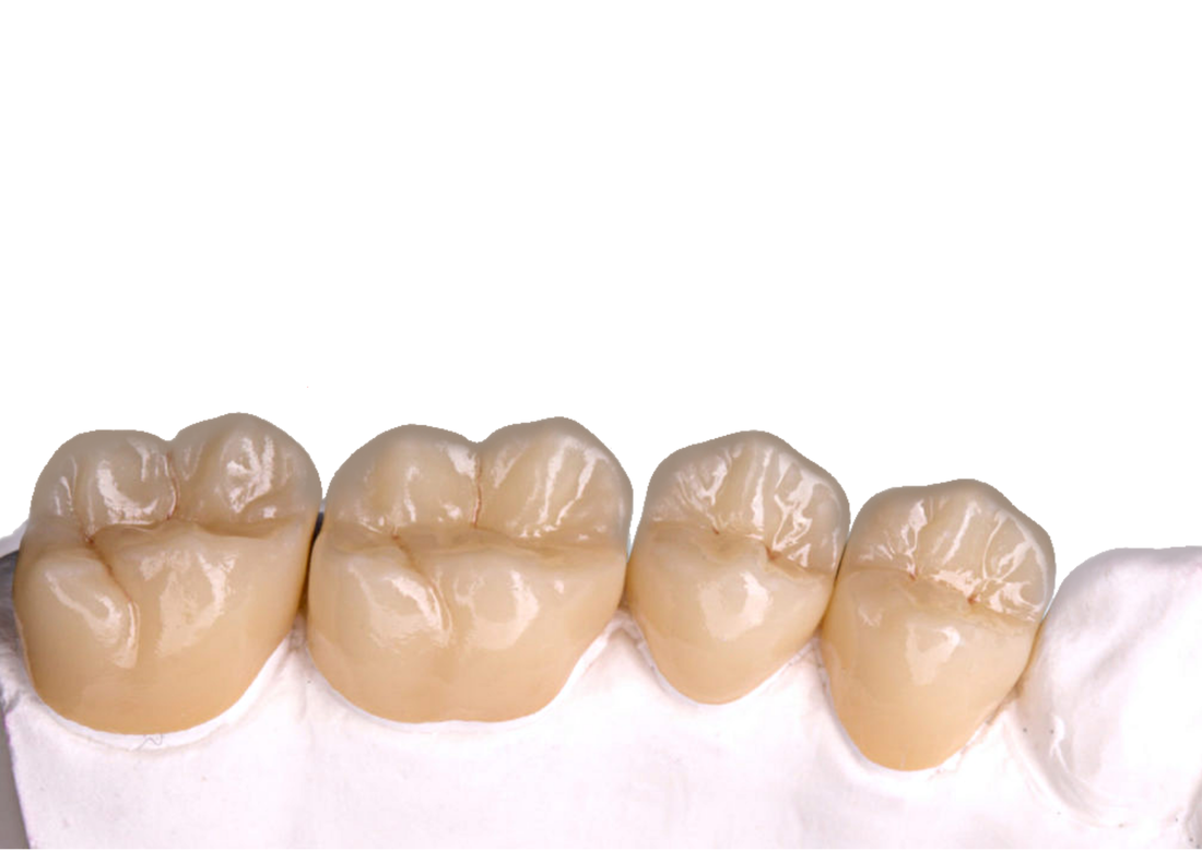 full-contour-zirconia-posterior-crowns_orig