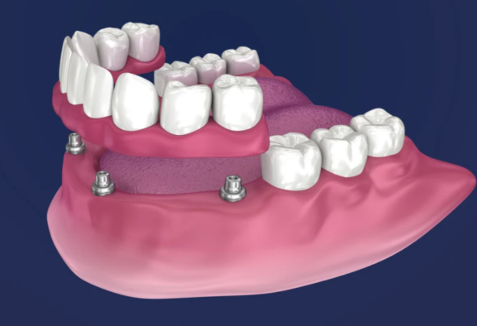 Transforming Smiles with BDL’s Implant Dentures